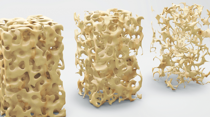 Bone structure 3-D illustration, normal and with osteoporosis. Stock illustration.