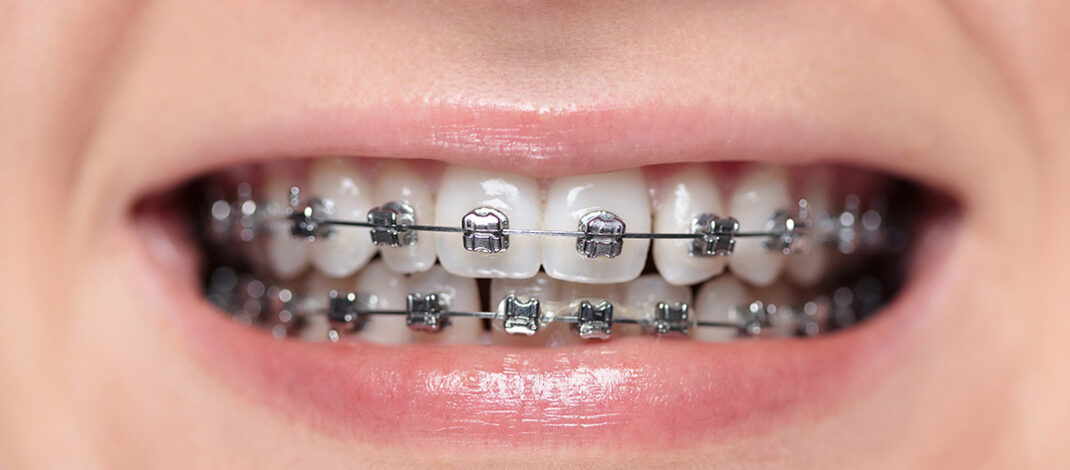 ‘Never Been Cooler’: Metal Braces Making Comeback