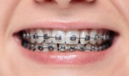 ‘Never Been Cooler’: Metal Braces Making Comeback