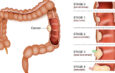 Colon Cancer Now Top Cancer Killer for People Under 50