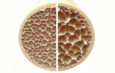 Do Men Get Osteoporosis?