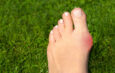 Simple Ways to Soothe Bunion Pain